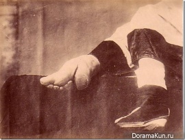 Китай. Деформация ступней.